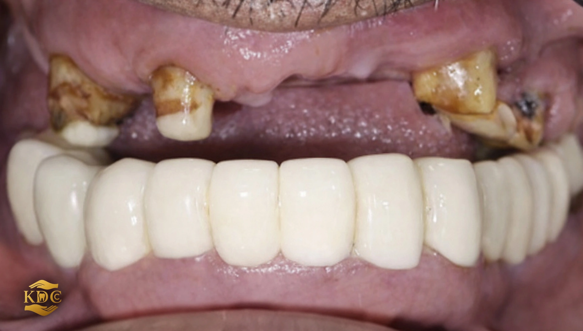 Full mouth Rehabilitation